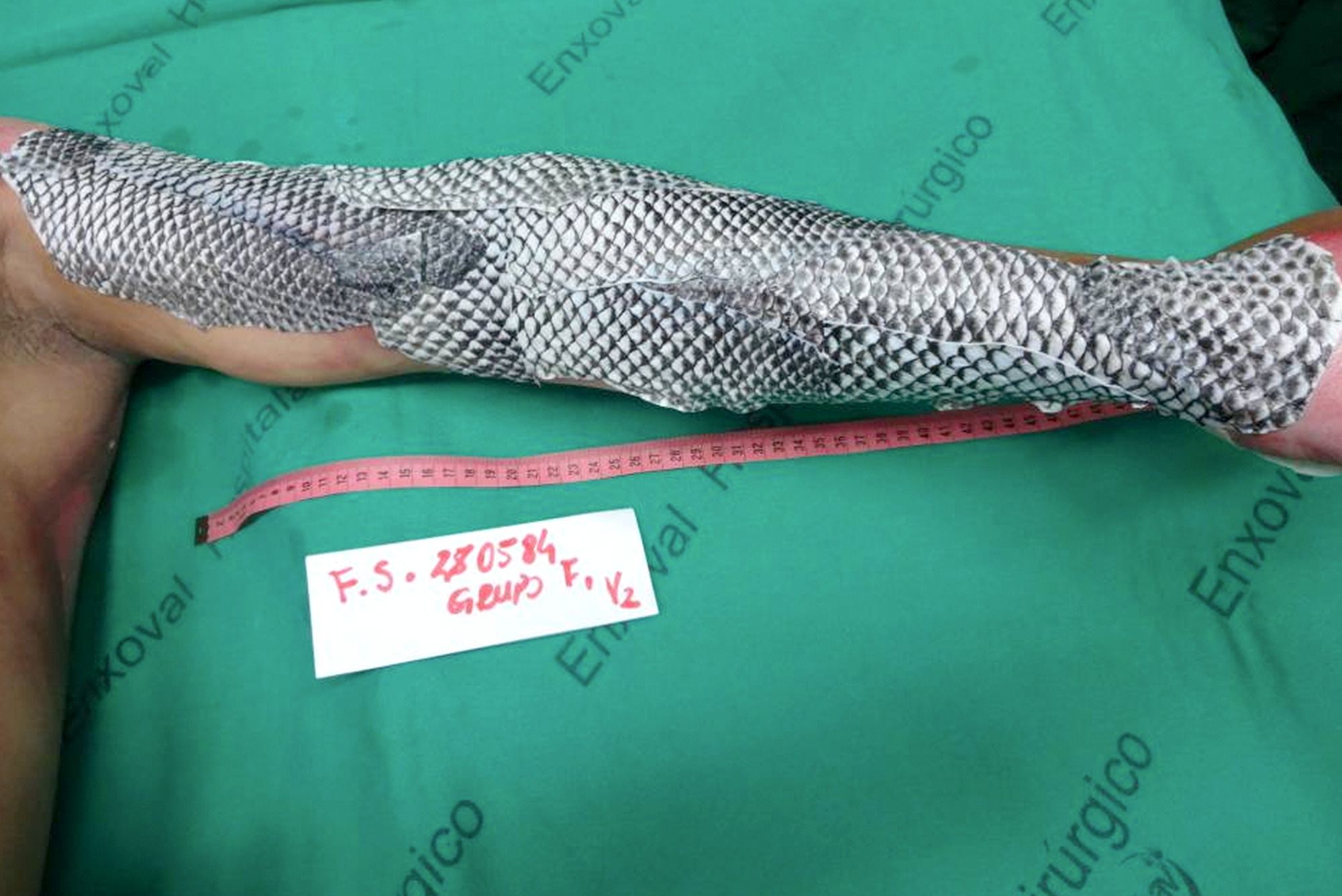 Fish Skin Graft Is A Novel Treatment On Burn Victims, Hard, 46% OFF