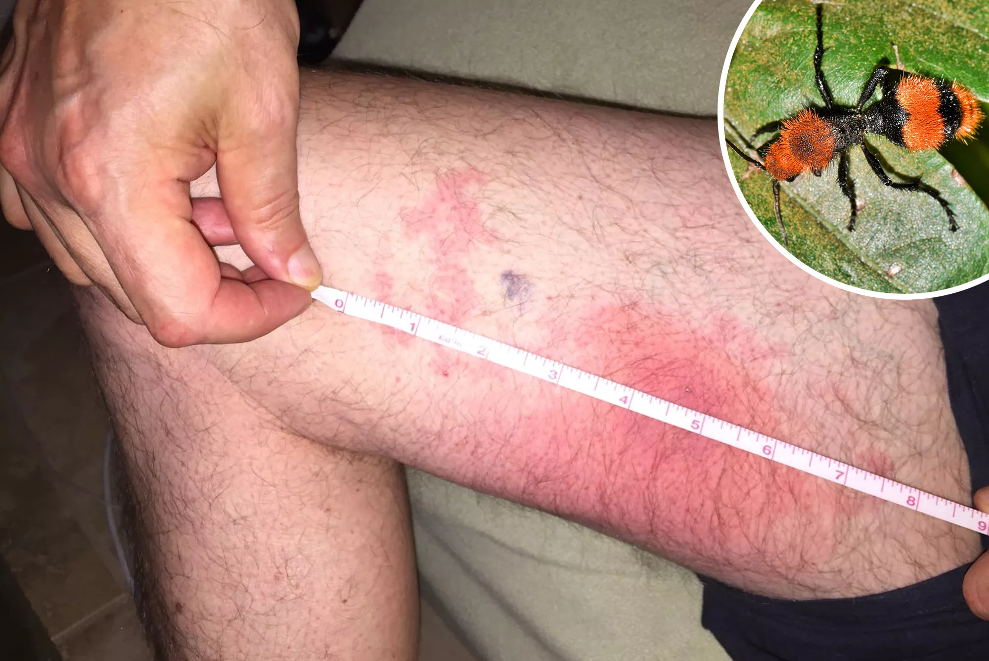 Florida Man in Excruciating Pain After Being Stung by 'Cow Killer' Ant - Vimarsana News