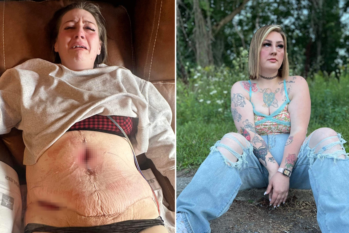 Woman Who Lost 200 Pounds Reveals 'Horrific' Results of Tummy Tuck