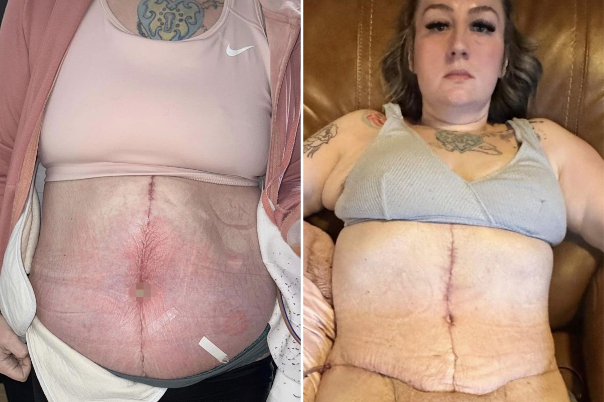 Patient With Botched Tummy Tuck Gets Makeover You Won't Believe