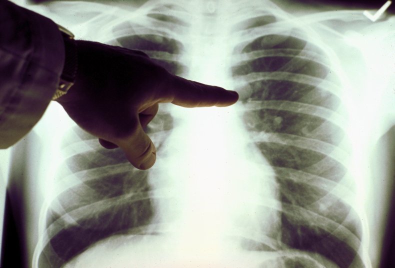 Lung X-ray
