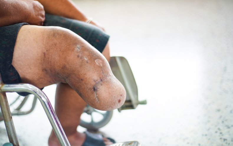 amputated leg