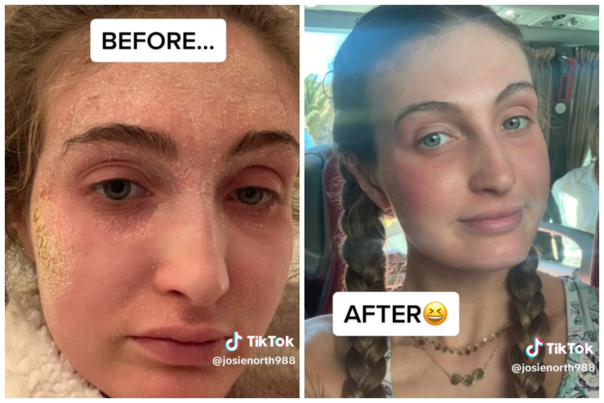 Woman Looks Unrecognizable As Severe Skin Condition Heals On 7 Day 