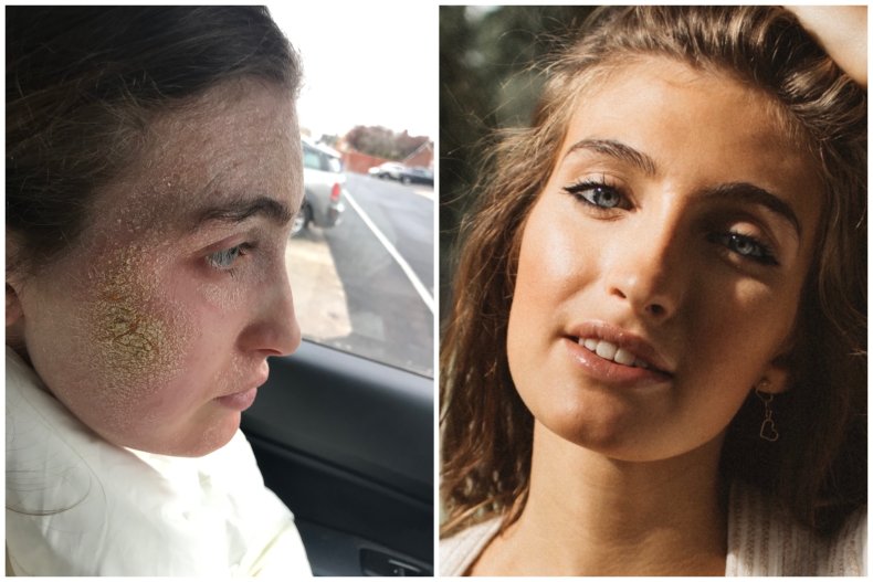Steroid Fall Woman Looks Unrecognizable As Severe Skin Condition Heals on 7-Day Vacation