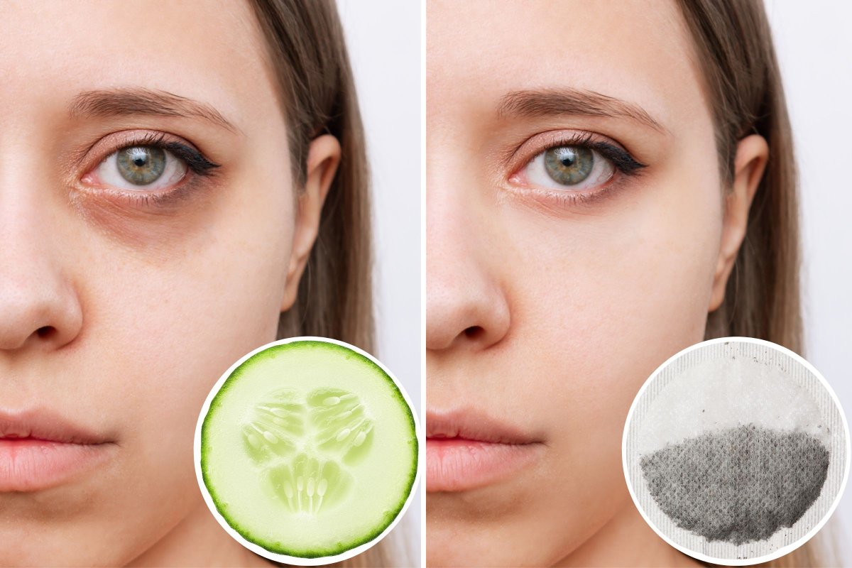 At-Home Remedies to Fix Under-Eye Bags, as Recommended by Ophthalmologists