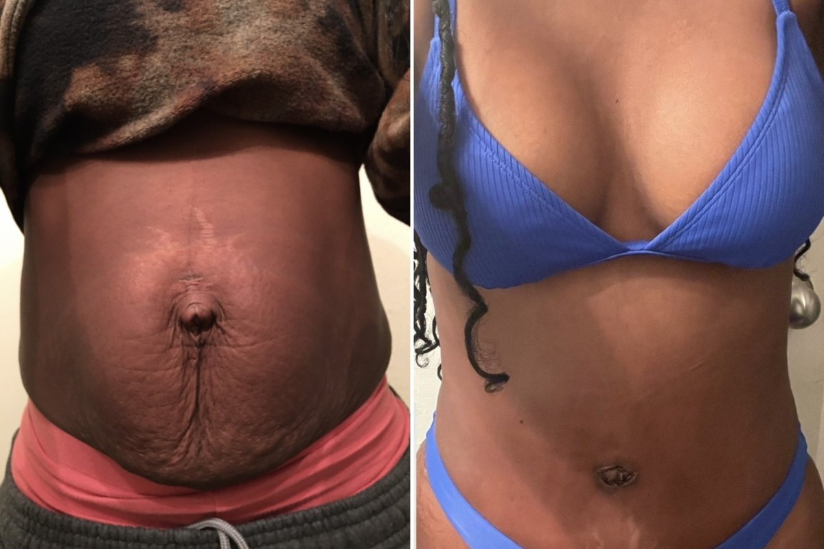 Tummy Tuck Fort Worth