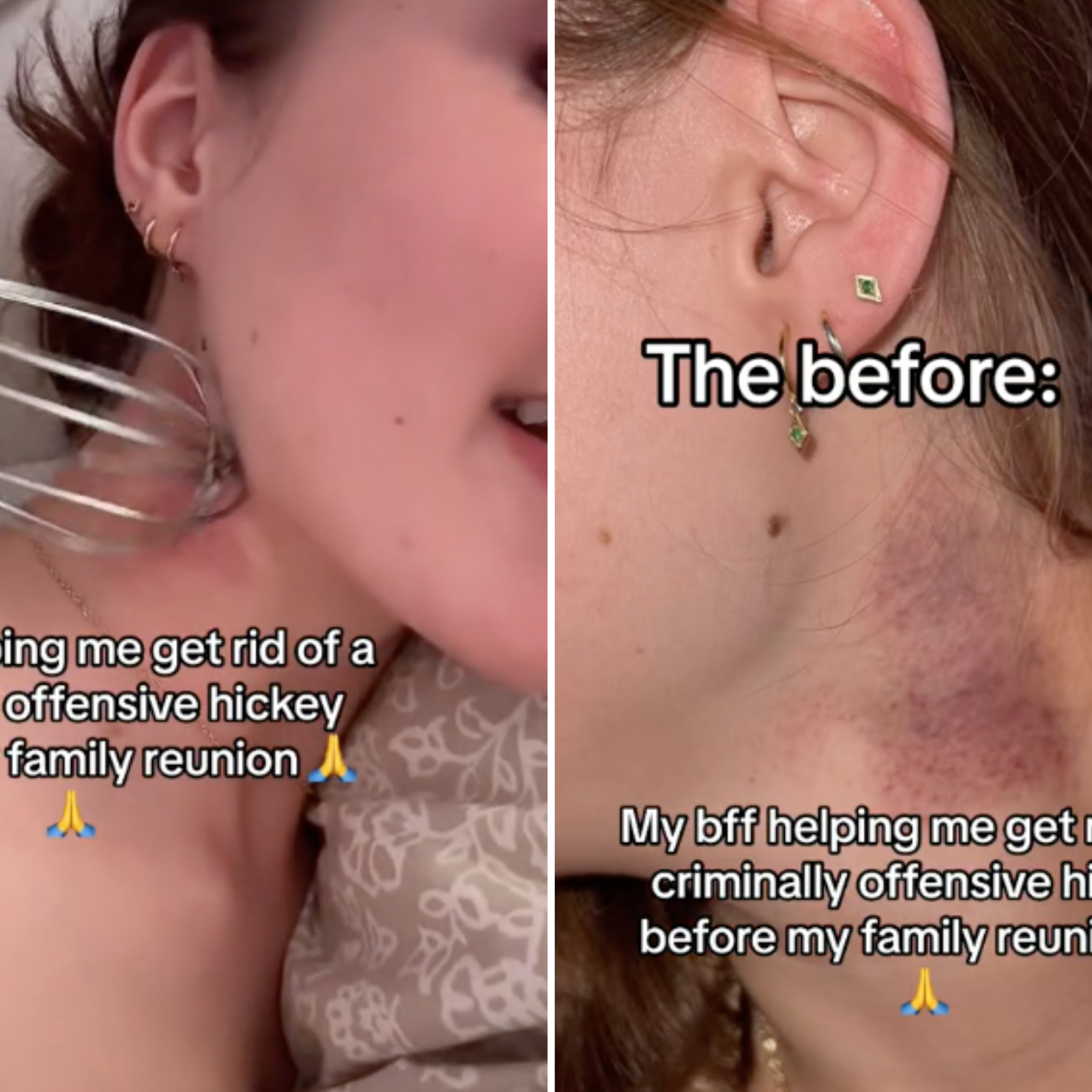Woman Tries To Get Rid Of 'Criminally Offensive' Hickey Before Family Event