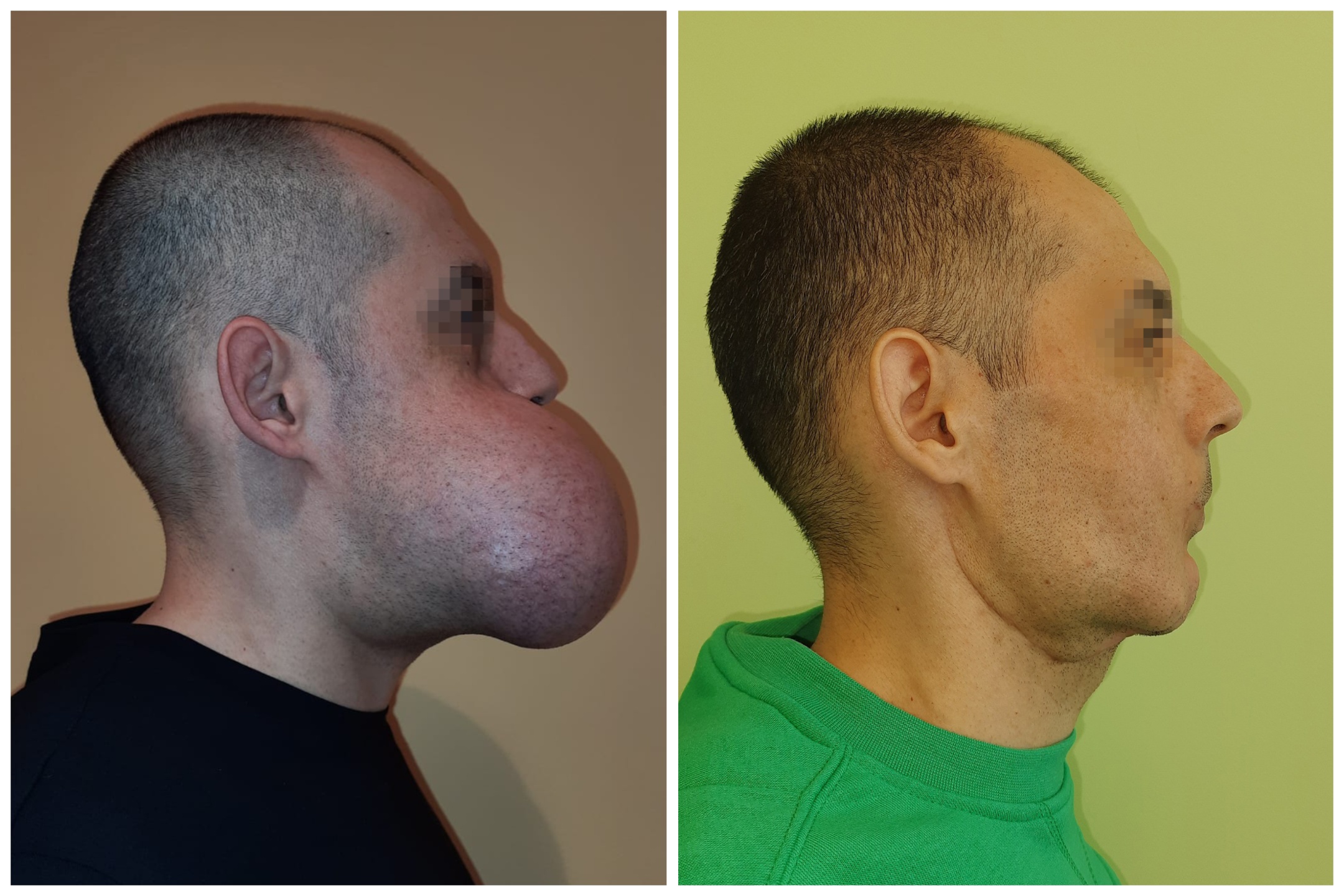 Tumor Removal Before And After