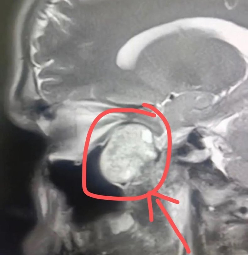 Brain tumor