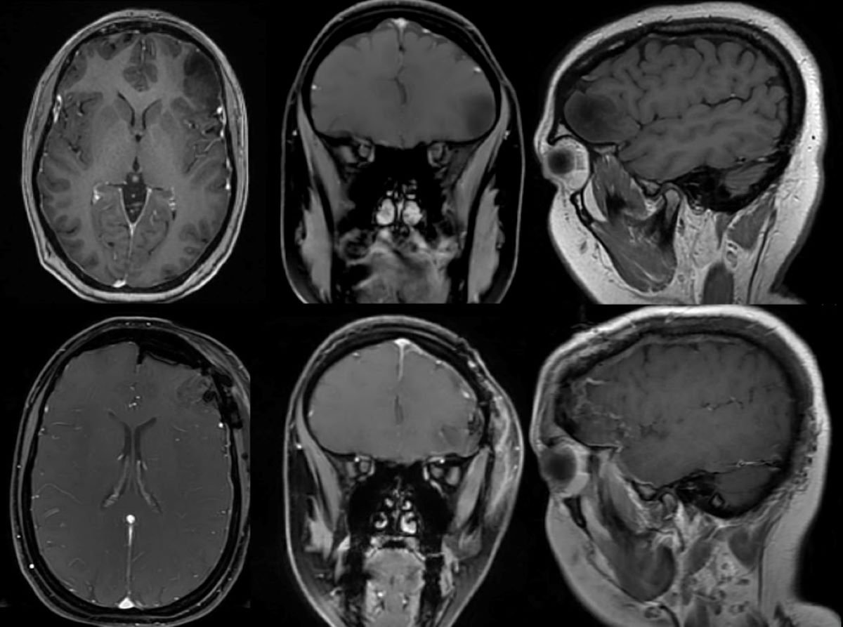 Incredible Video Shows Woman Singing Moana During Brain Surgery Incredible Video Shows Woman Singing Moana During Brain Surgery