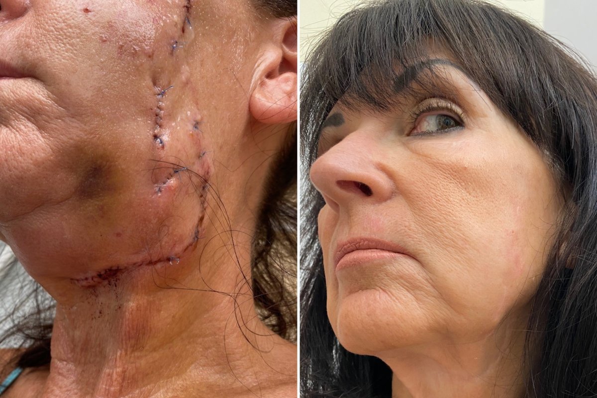 Rhonda Sitterly Was attacked by a pitbull