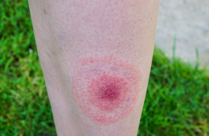 lyme disease tick bite