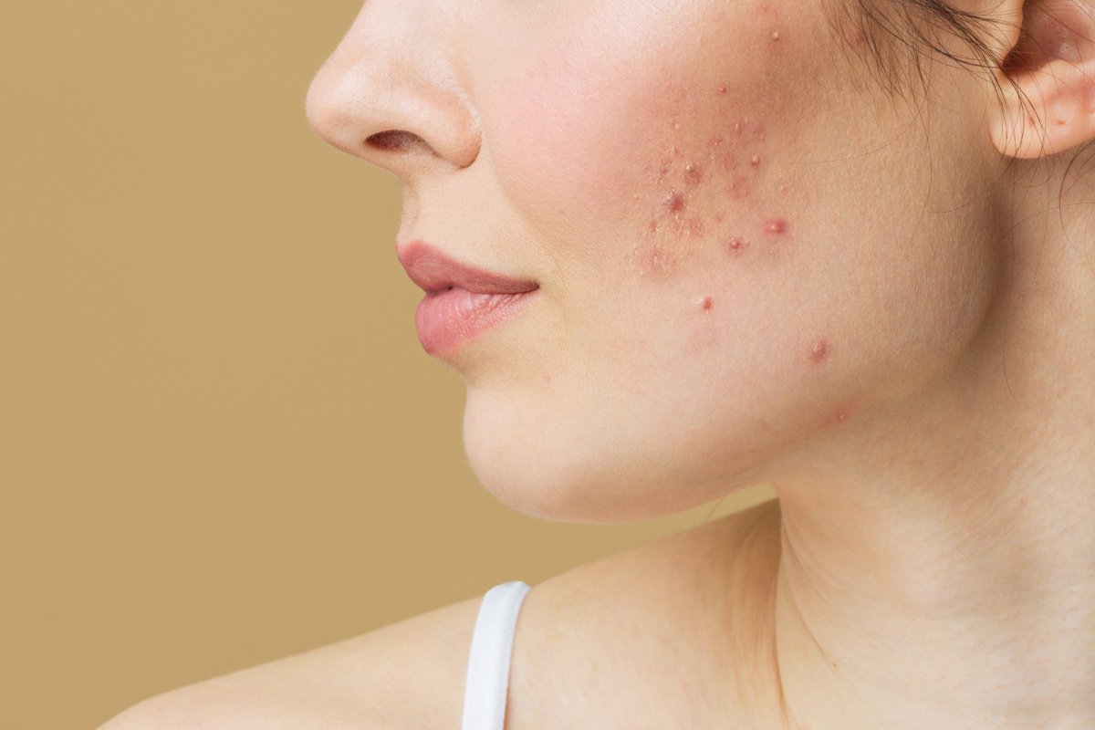 Pimples on skin 