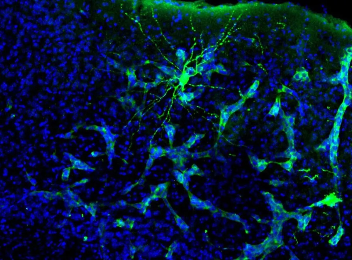 Brain Tumors Found To Hack Brain's Activity in 'Paradigm Shift' Discovery - Vimarsana News