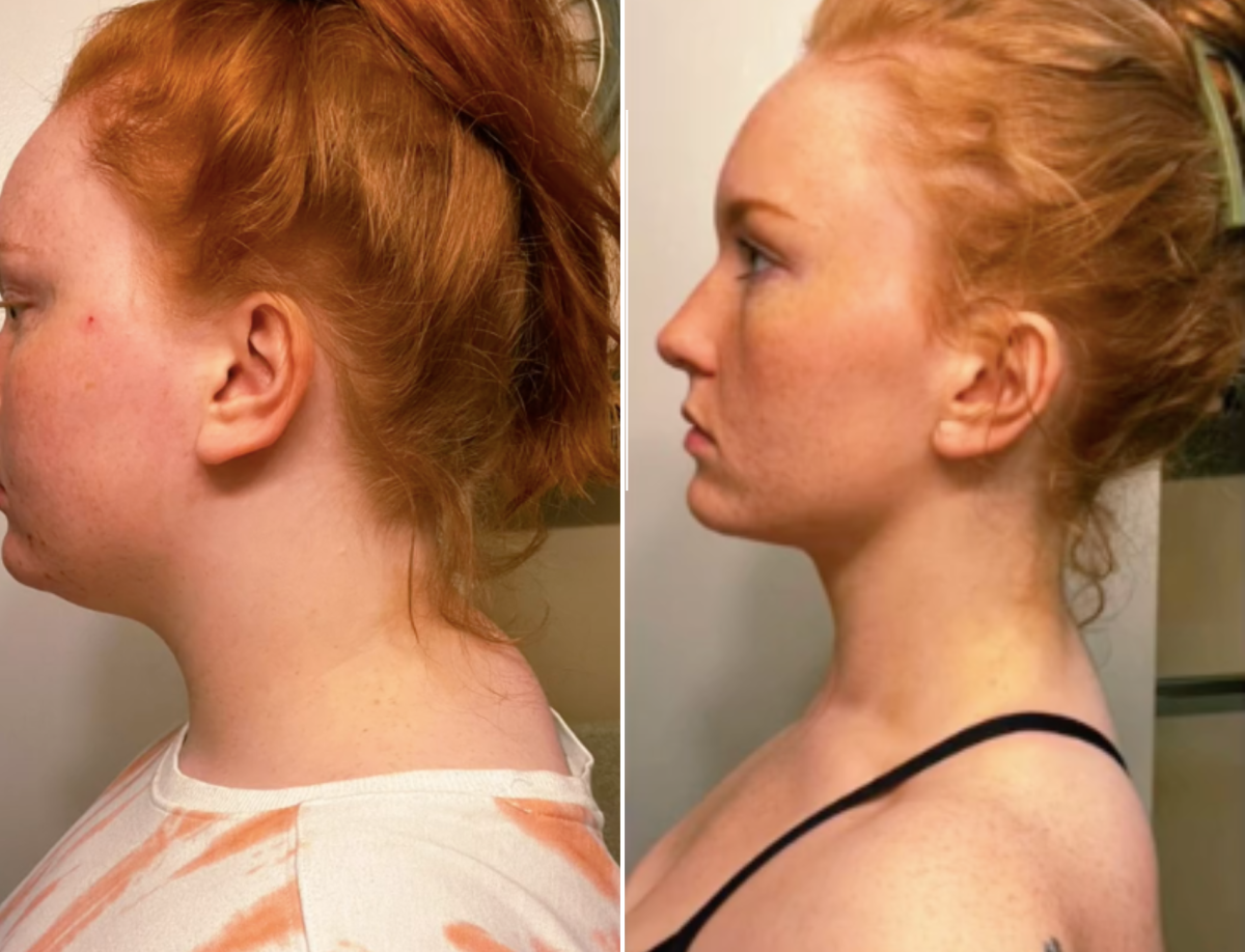 Woman Shares Exercises She Claims Fixed Her 'Tech Neck' in Eight