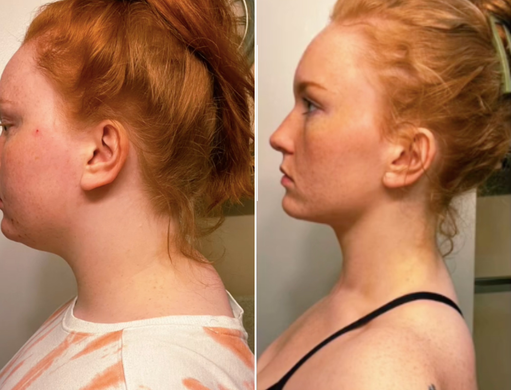 Woman Shares Exercises She Claims Fixed Her Tech Neck In Eight Months 