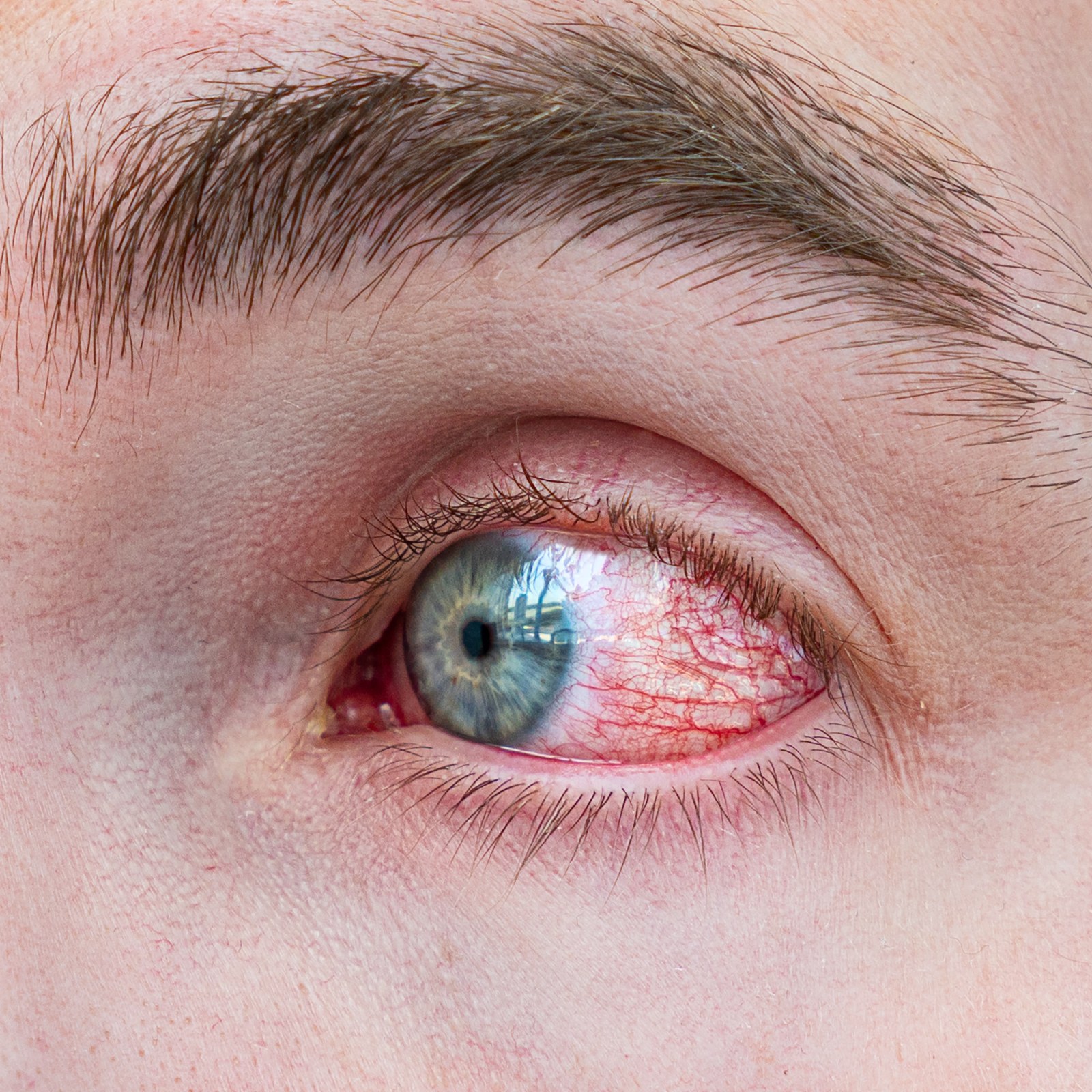 Pink Eye Work Rim Worst Case Of Pink Eye