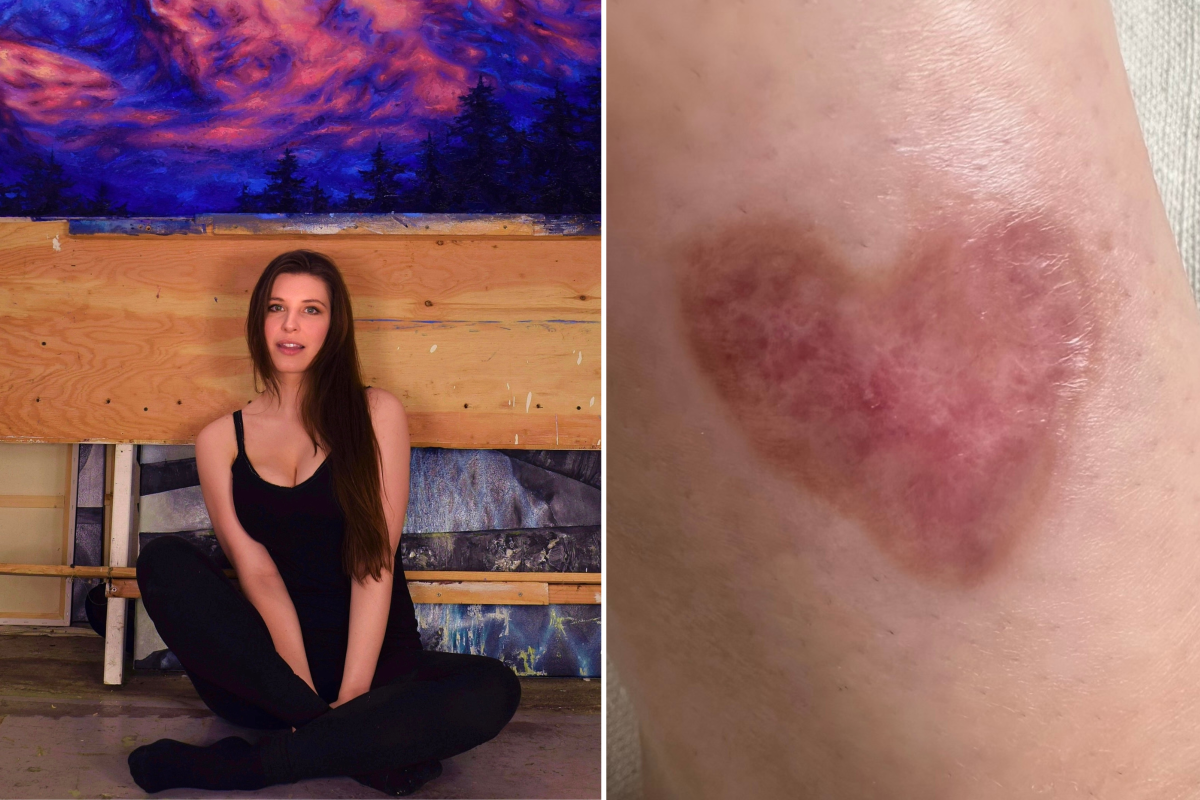 Shelby Alexandra and spider bite