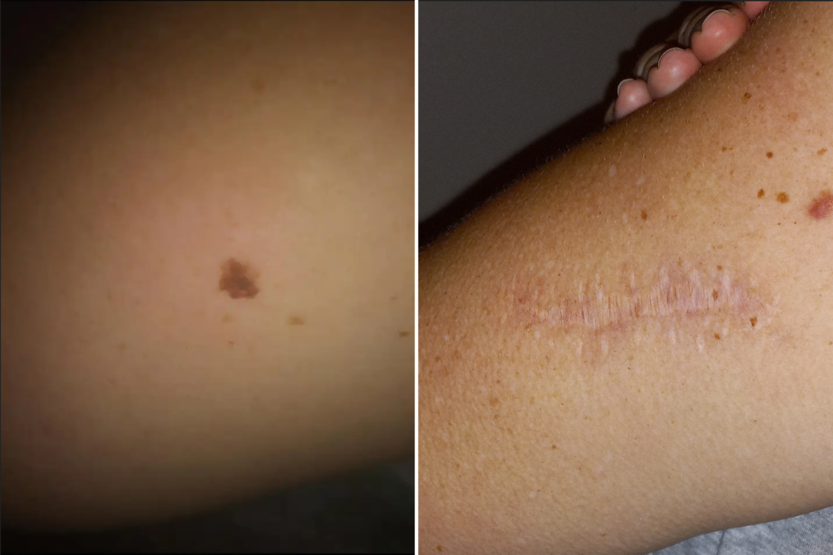Kelly Avery's cancer mark