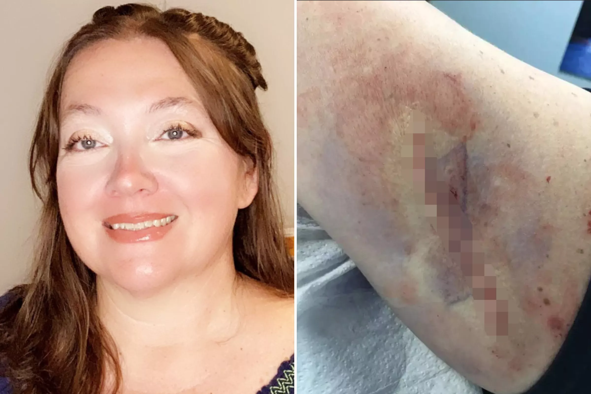 Woman's Colleague Spots Mark on Her Arm That Led to Cancer Diagnosis - Vimarsana News