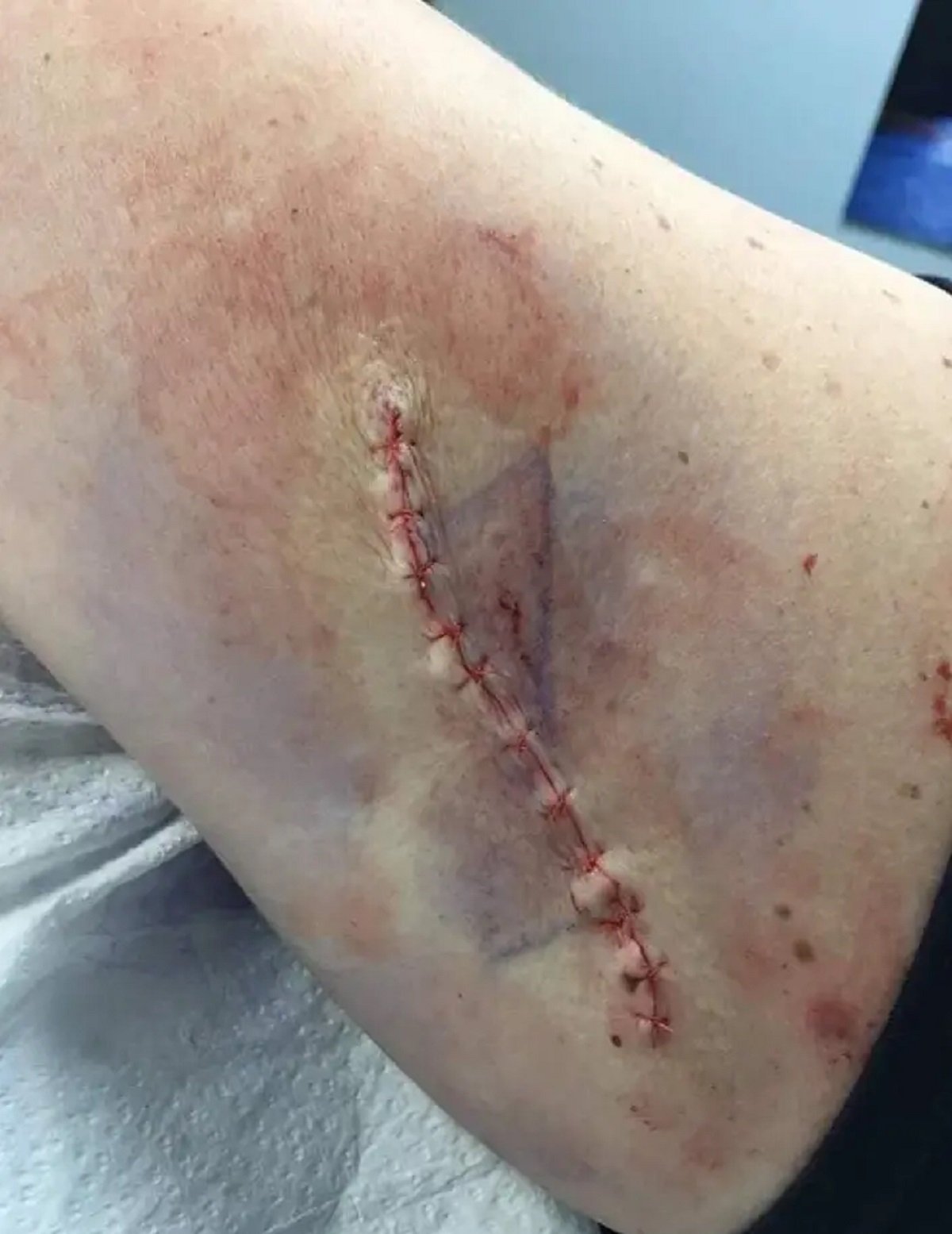 Kelly Avery's melanoma scar 