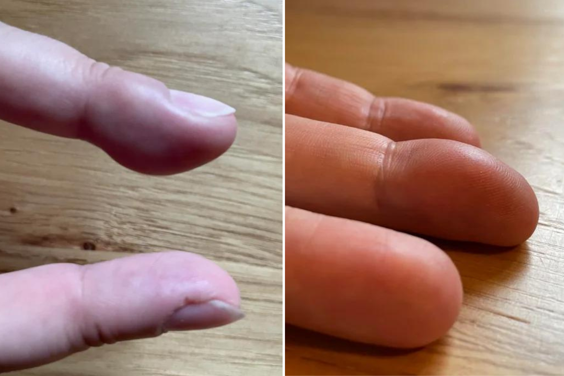 How To Remove A Ring That Stuck On Your Finger See Trick Video - Video: अगर  उंगली में अटक गई है अंगूठी, तो इन कमाल की Tricks से झटपट निकालें बाहर