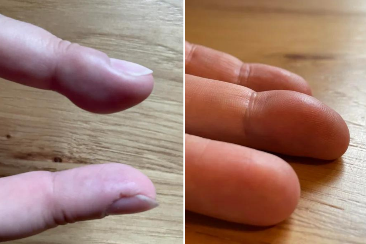 A doctor showed me how to remove the ring that was stuck on my finger 