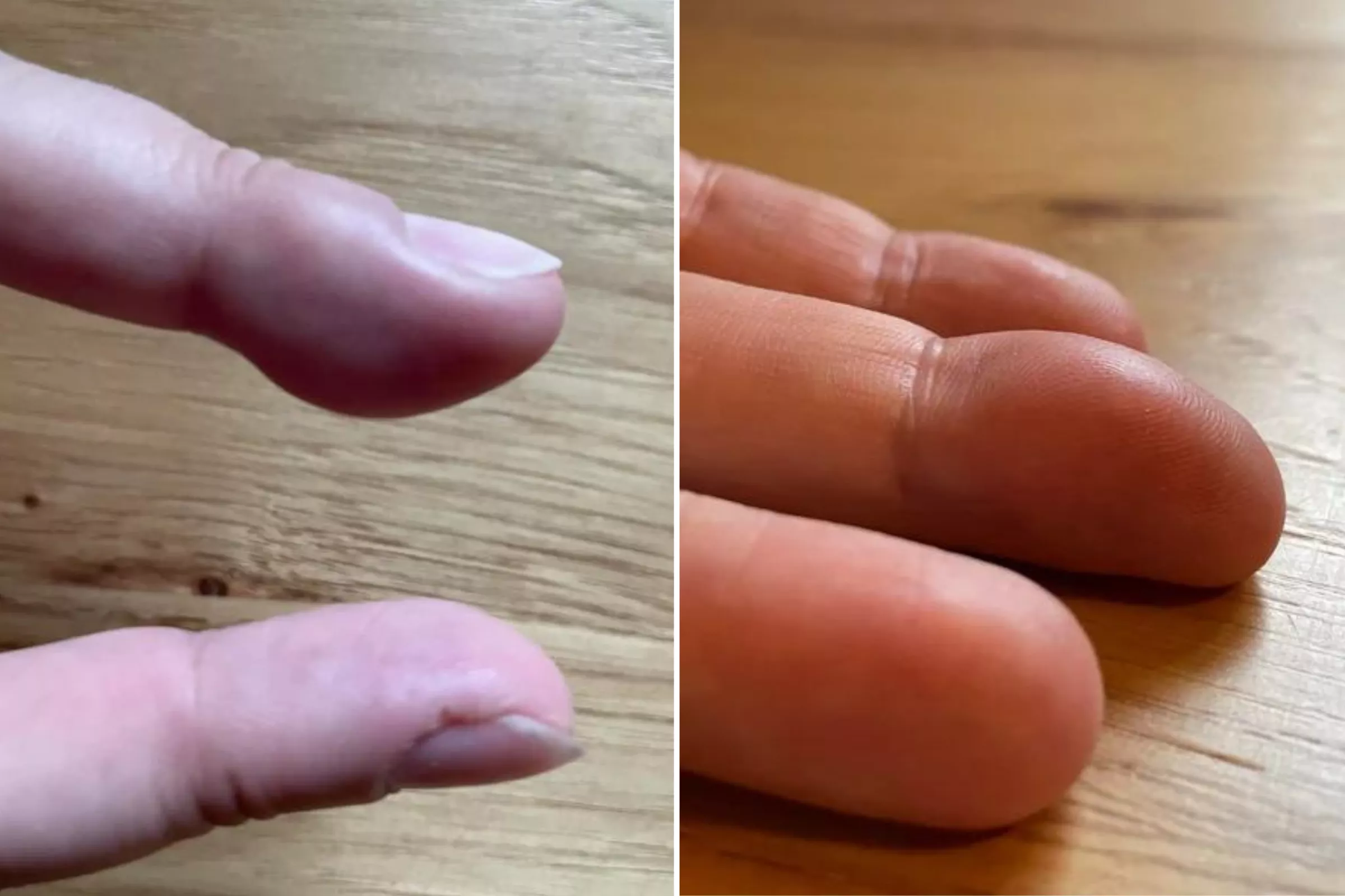Woman Gets Unusual Diagnosis After Waking Up With Suddenly Huge Finger - Vimarsana News
