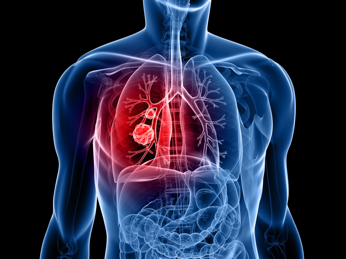 lung tumor