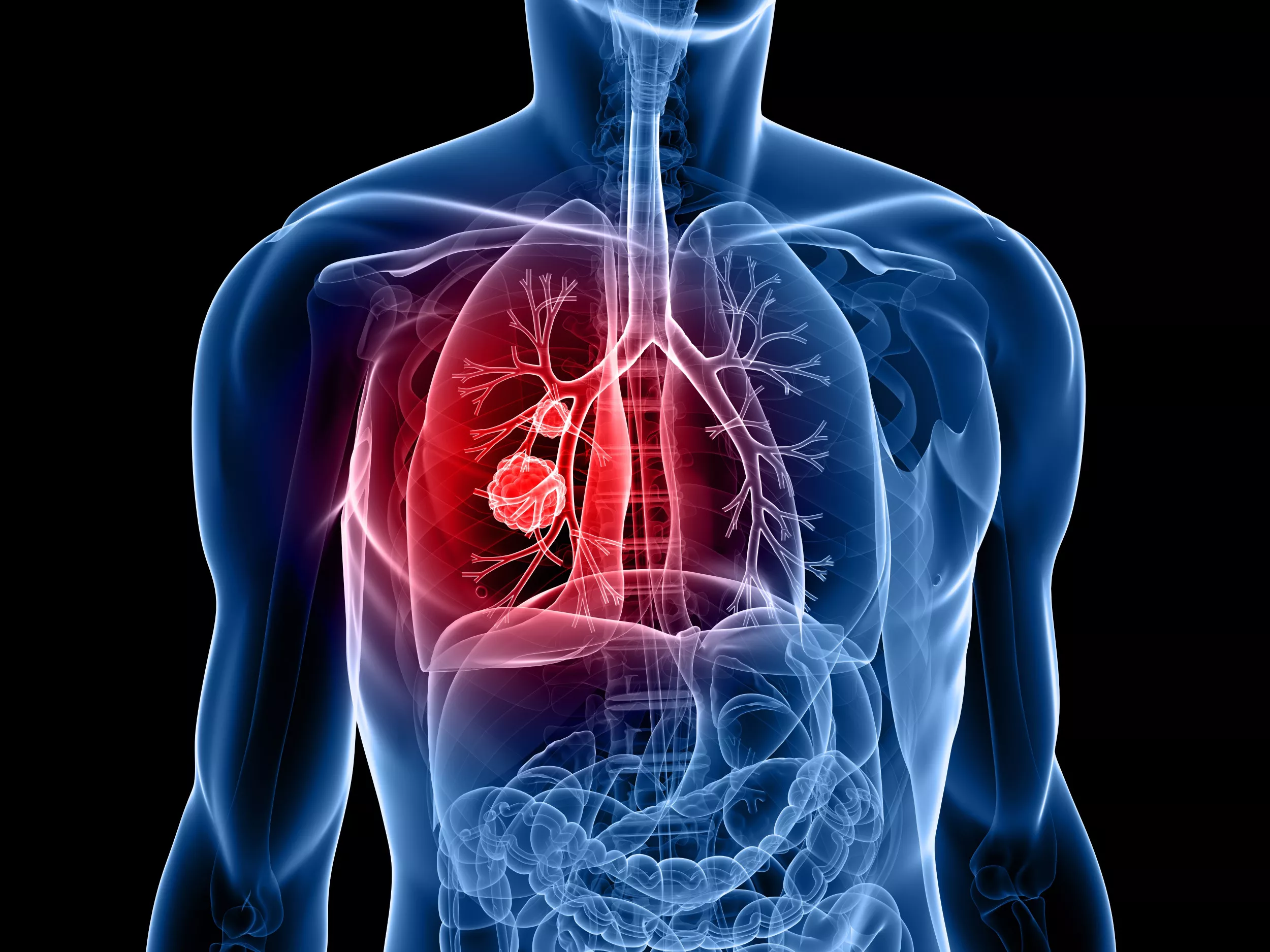 Scientists Identify Protein Combination That Can Stop Lung Cancer Growth - Vimarsana News
