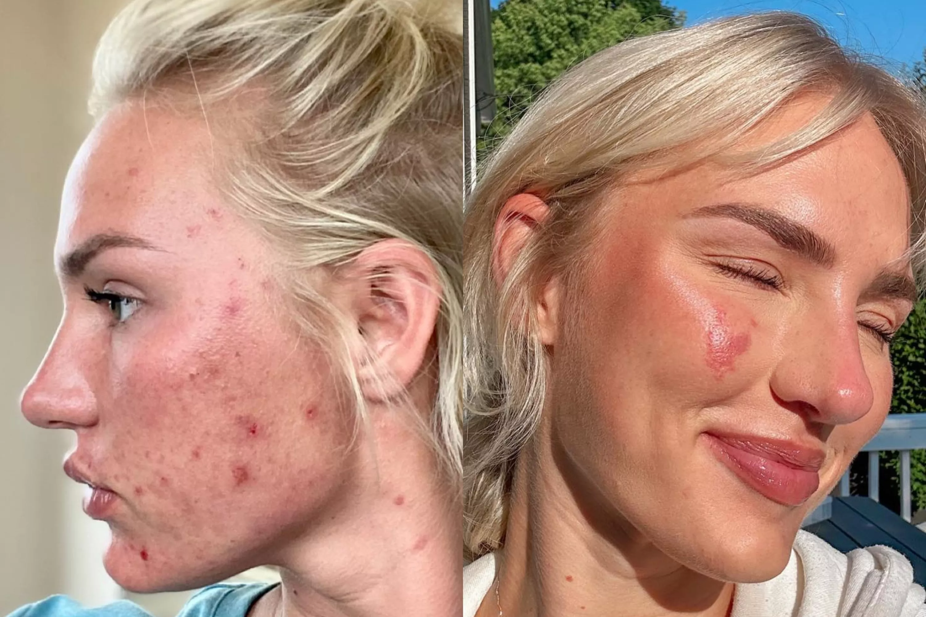 I Tried Everything to Heal My Acne. One Change Made a Huge Difference - Vimarsana News