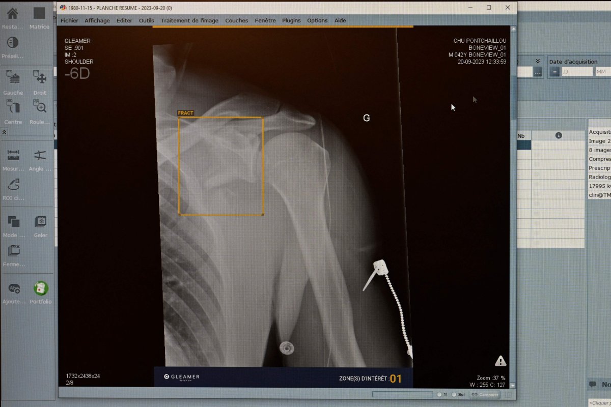 X-ray on screen