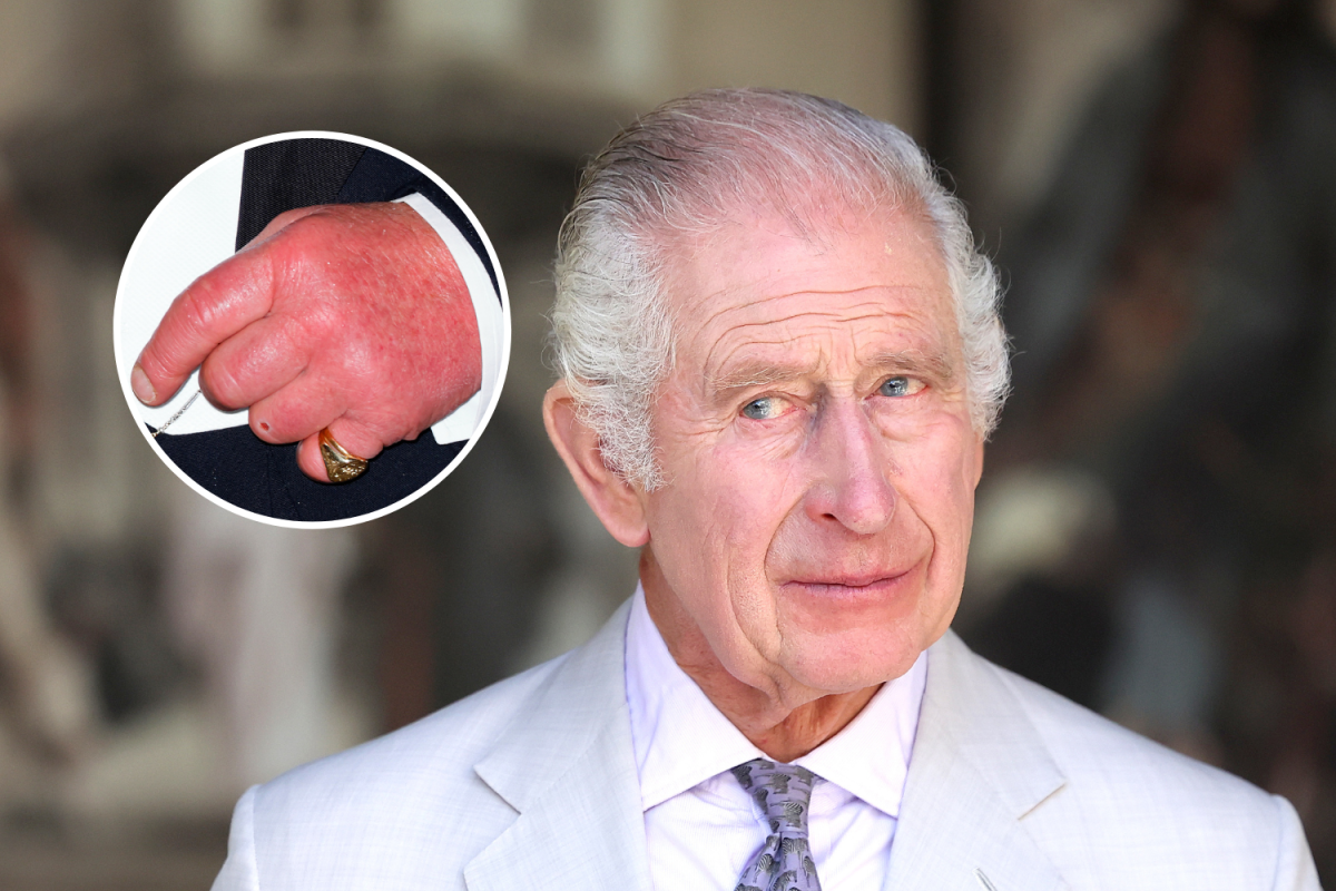 King Charles III 'Sausage Fingers'