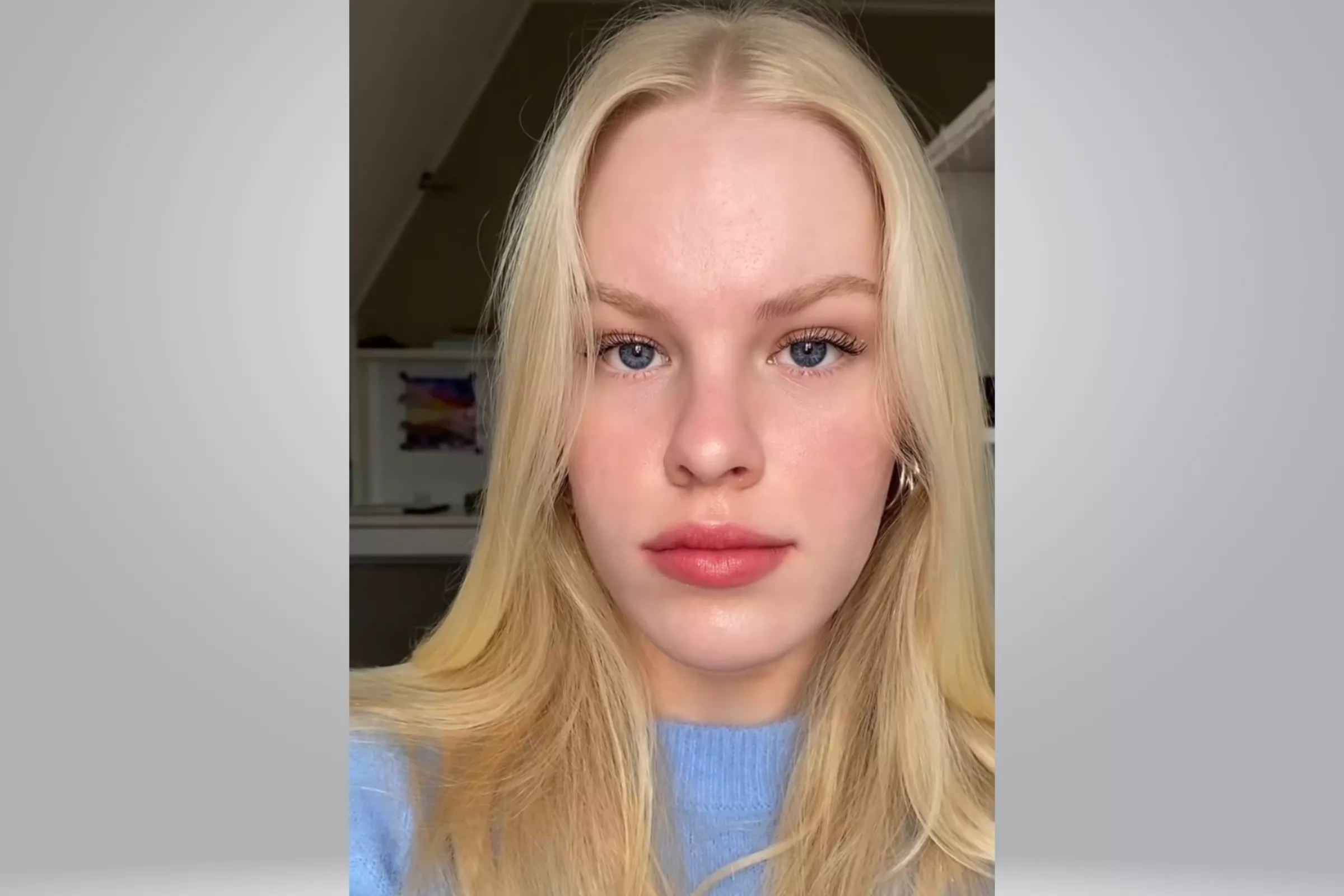 Woman With Acne Shares Incredible Two-Year Journey: 'Taken So Much Joy' - Vimarsana News