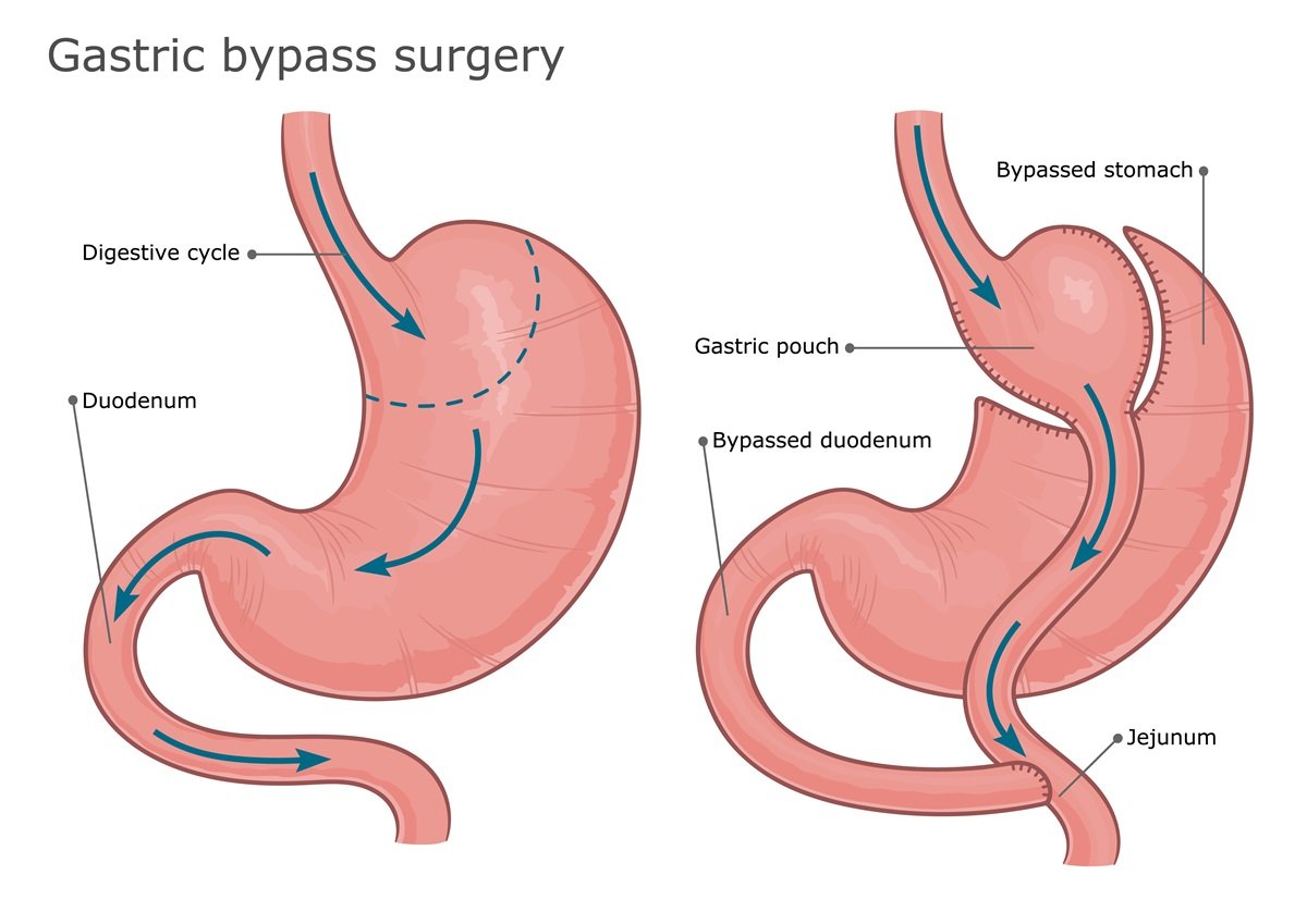 A diagram illustrates gastric bypass surgery