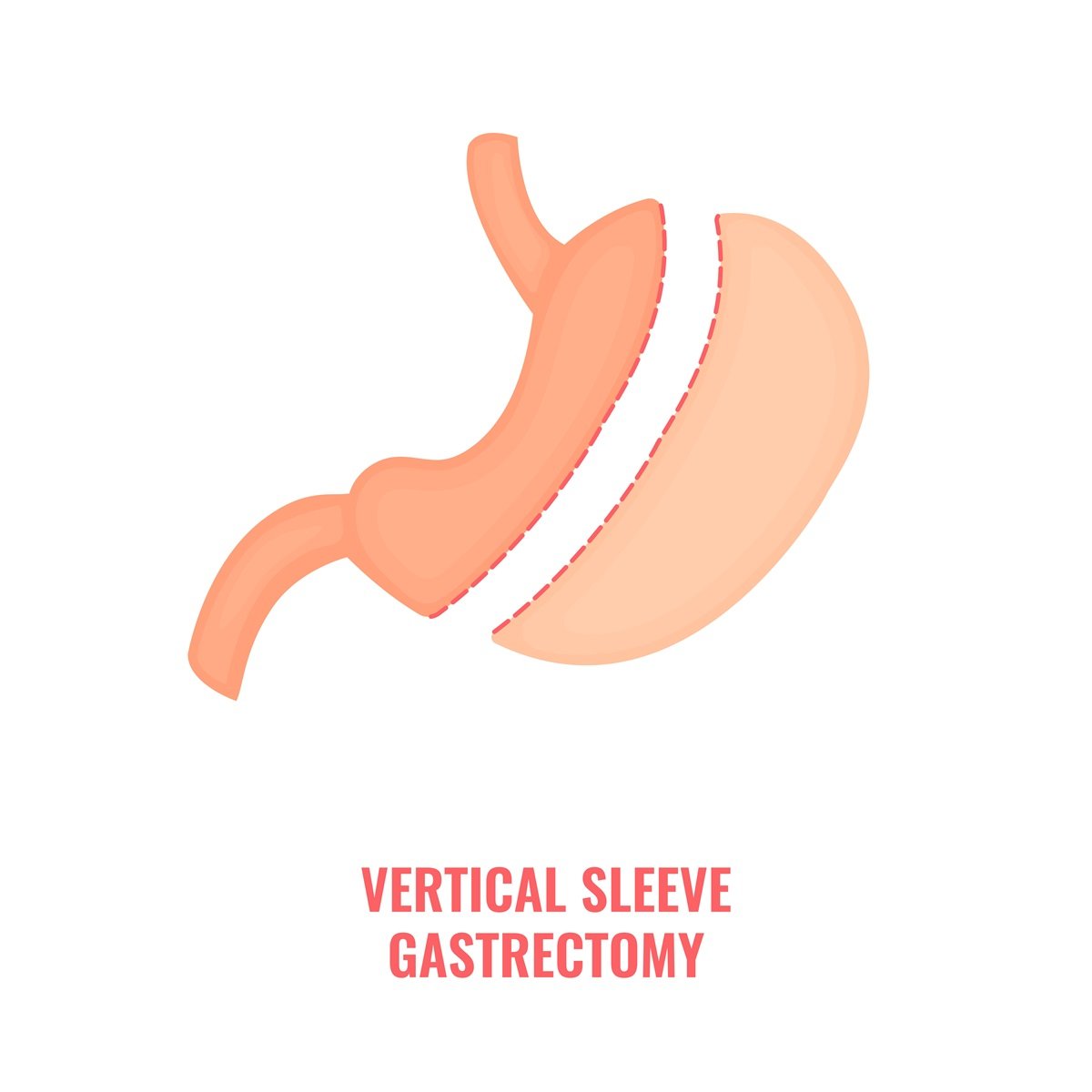A design illustrates a vertical gastric sleeve