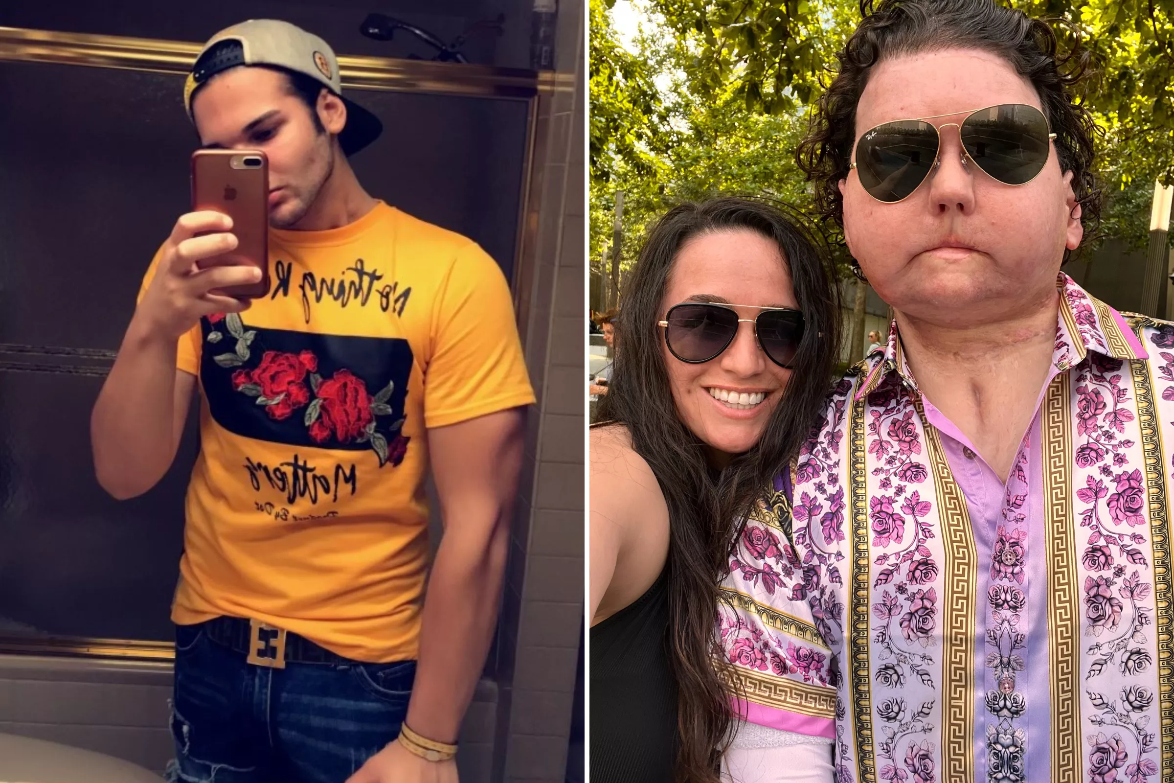 'I Had a Face Transplant—Now I've Found Love' - Vimarsana News