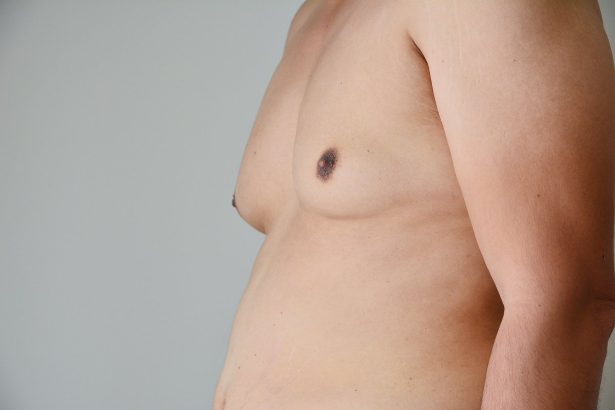 Breast enlargement in males Information