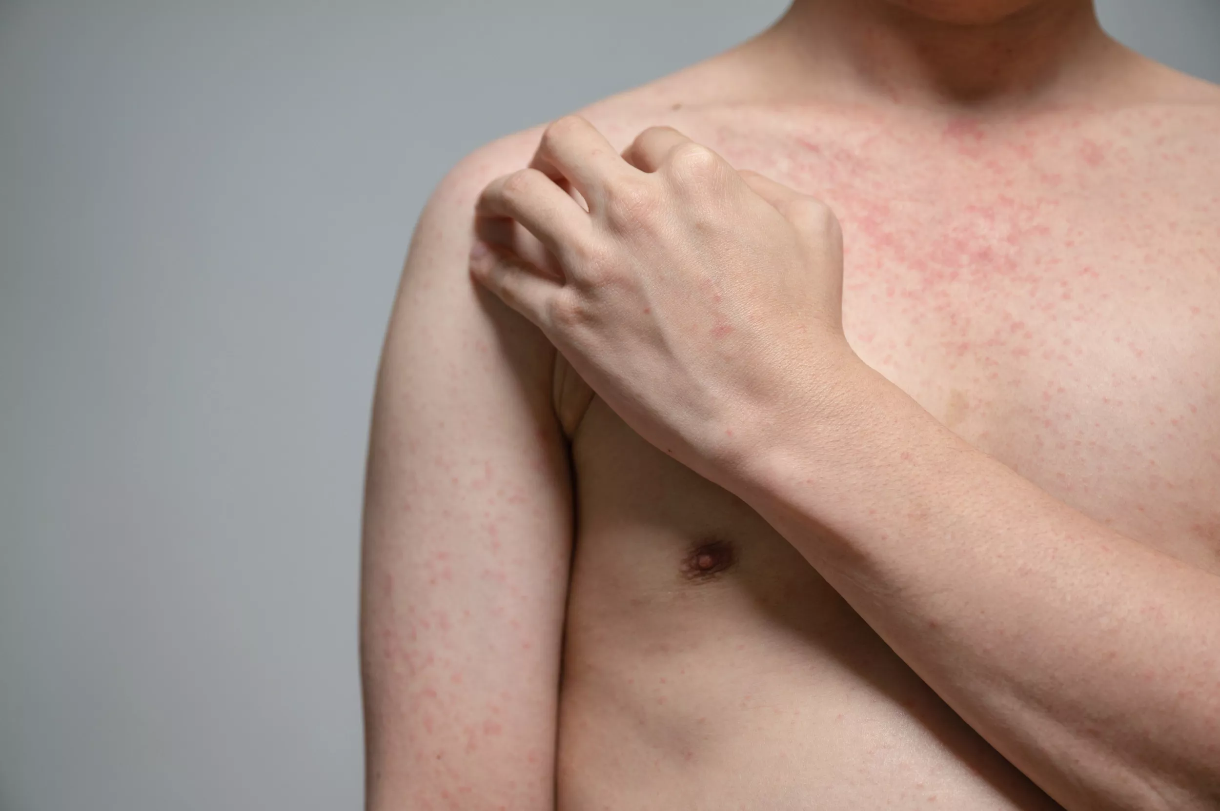 Measles Outbreak Map Shows States Where Cases Have Been Reported - Vimarsana News