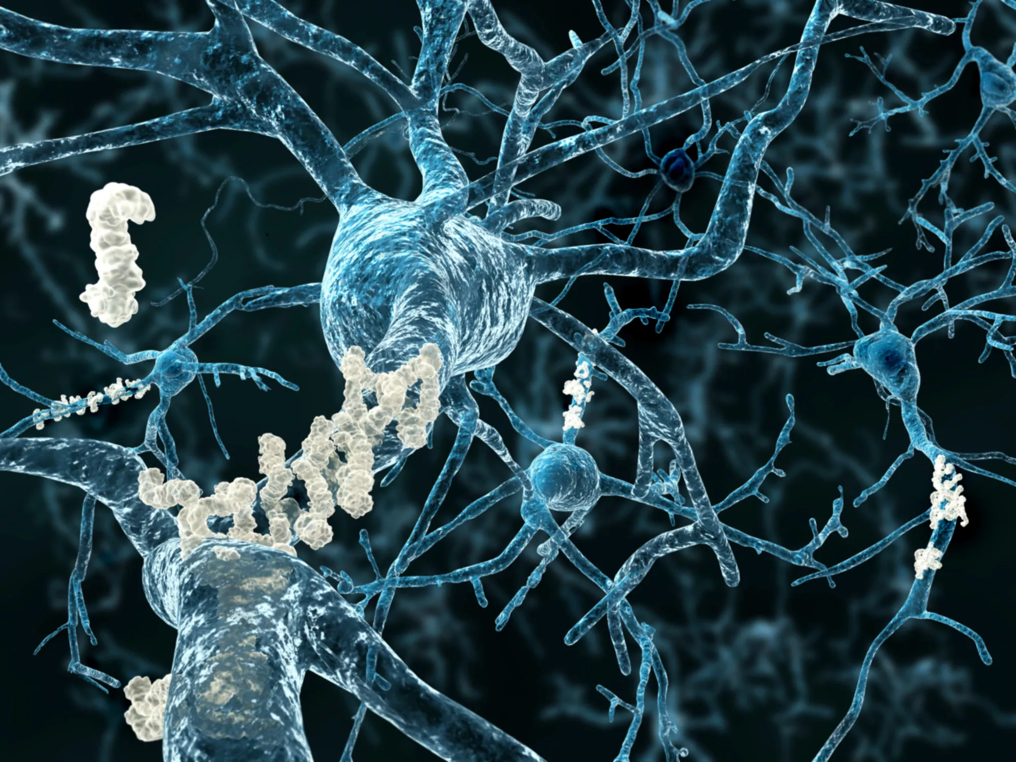 Alzheimer's Accidentally Spread to Several Humans via Corpse Transplants - Vimarsana News