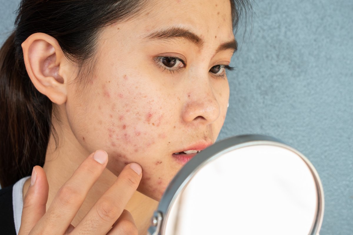 woman looking at acne