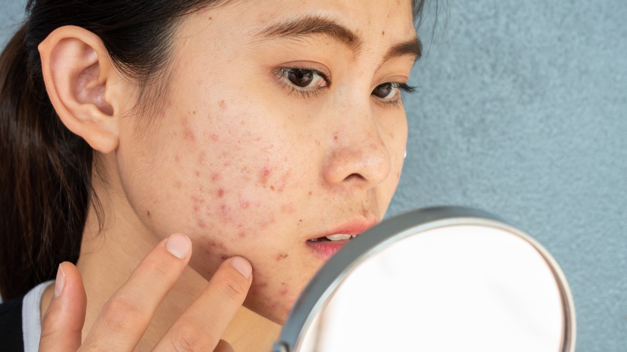 Woman Horrified to Discover Cause of Acne on Her Pillowcase the Whole Time - Newsweek