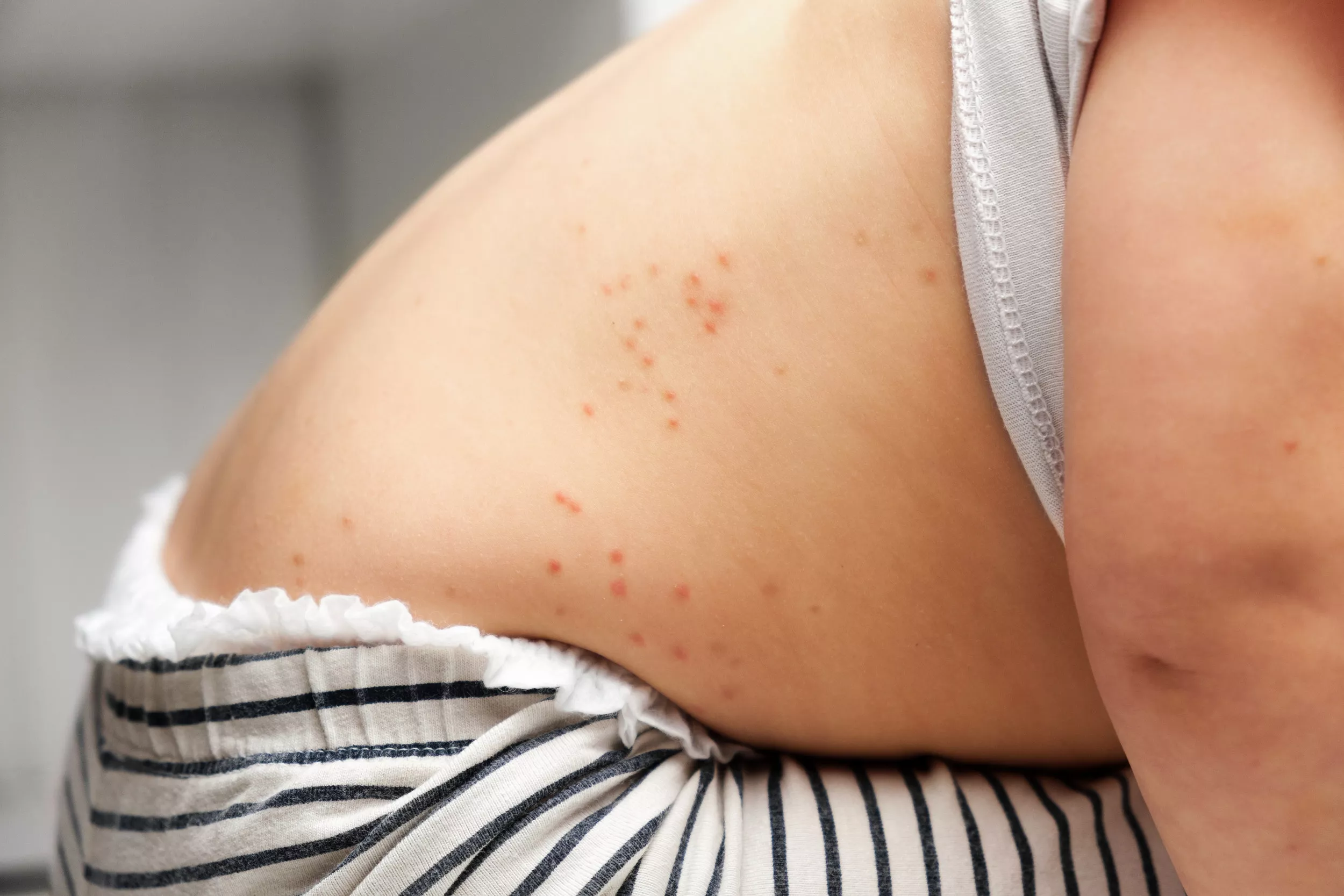 Measles Outbreak Map Shows Nine States Where Disease Reported - Vimarsana News