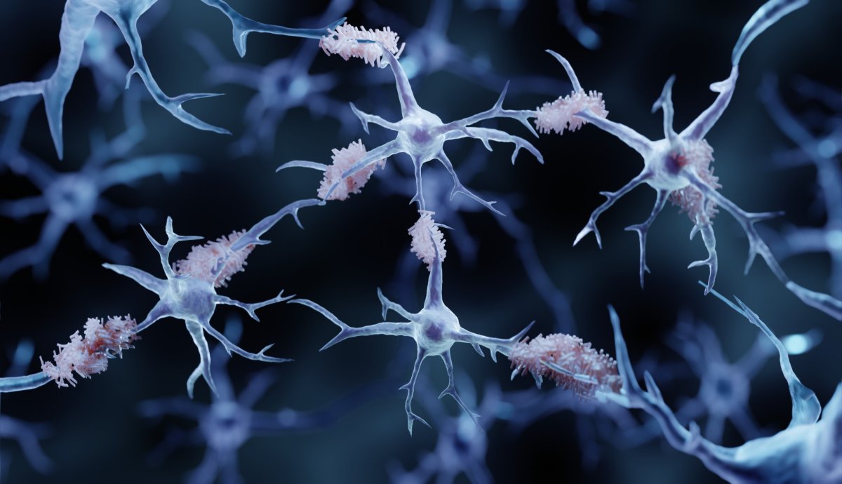 Alzheimer's protein aggregates around brain cells