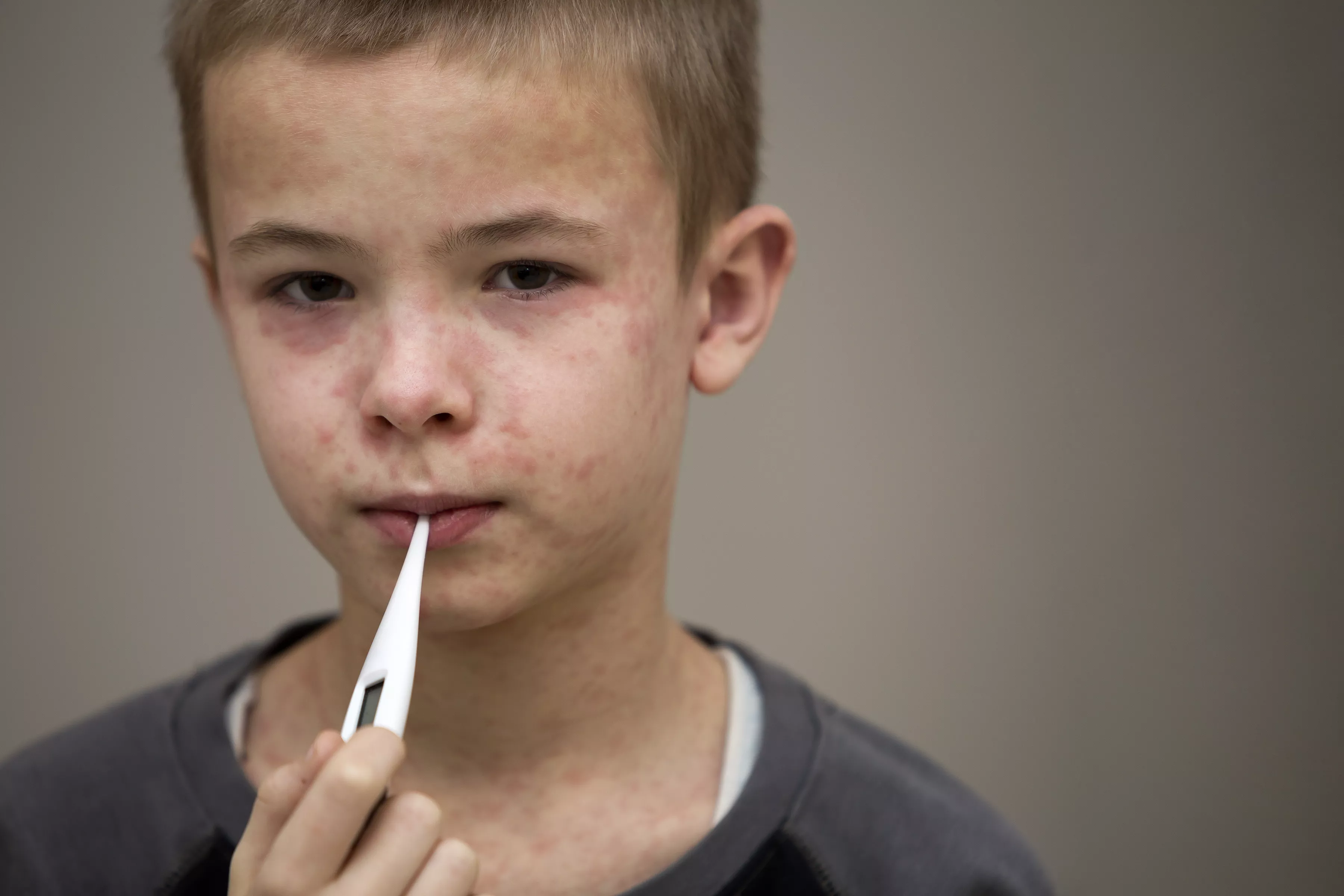 Florida Measles Outbreak Grows as New Case Reported - Vimarsana News