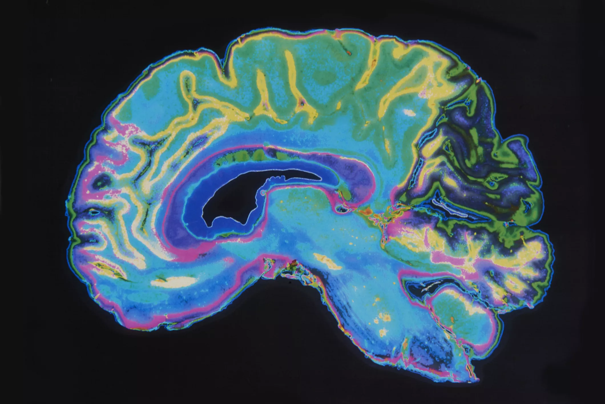 Flickering Light Can Slow Alzheimer's Disease, MIT Scientists Say - Vimarsana News