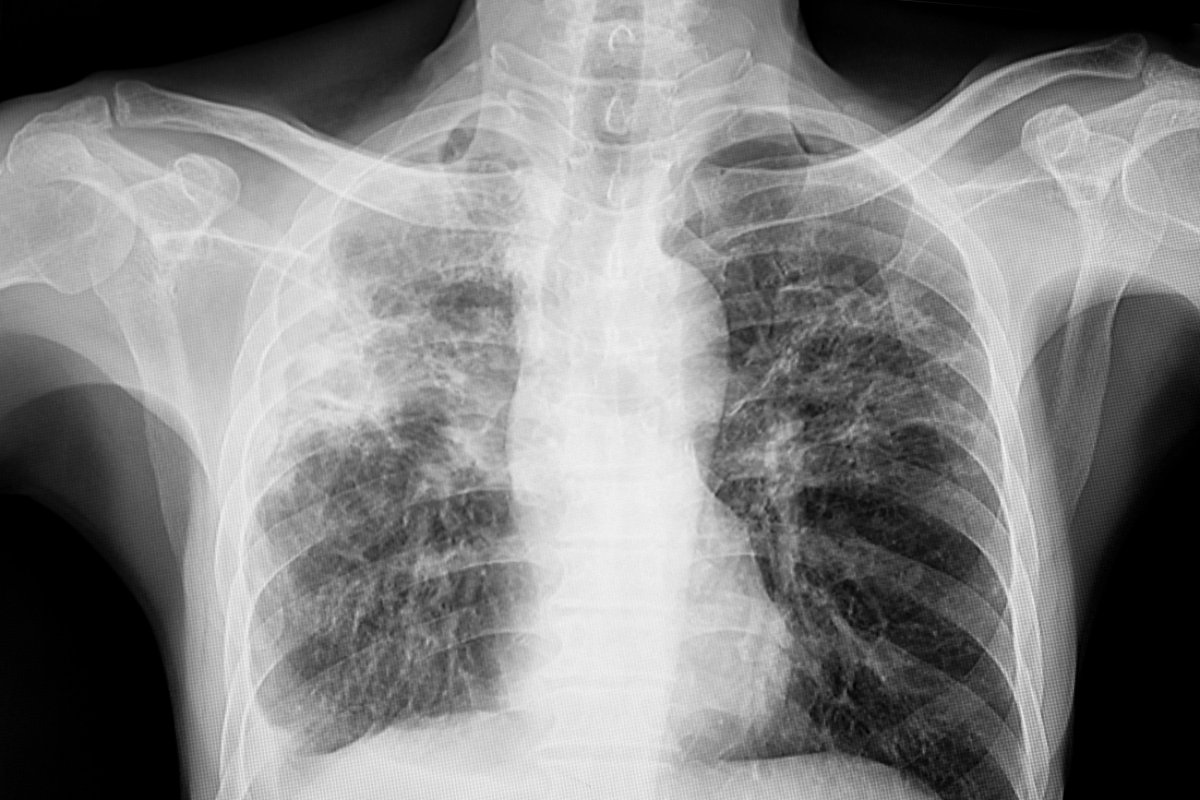 Tuberculosis x-ray