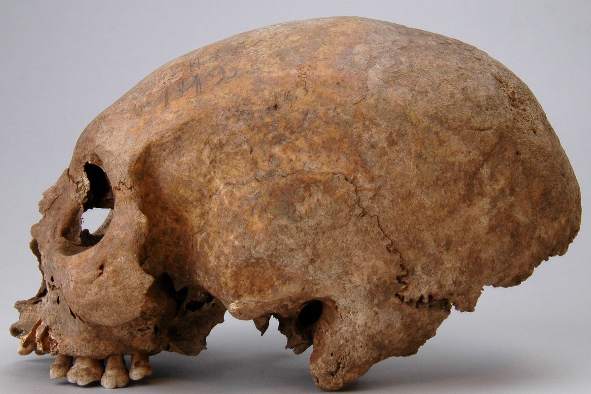 A deformed Viking Age skull