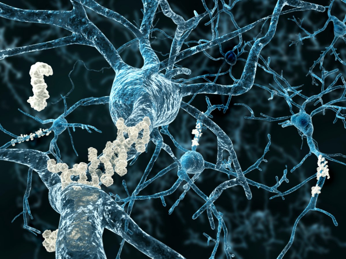Alzheimer's neurons