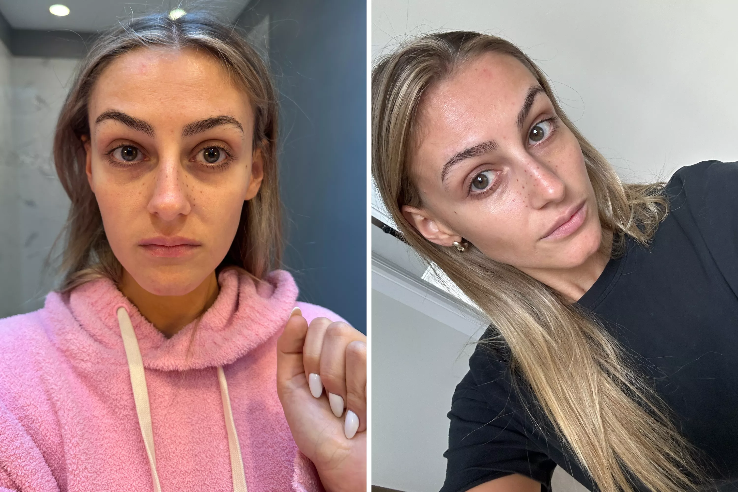 Woman Shares How Skin Looks 2 Weeks After Quitting Sugar, Processed Food - Vimarsana News